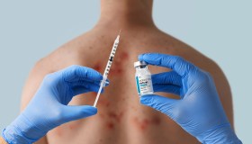 Vaiolo delle scimmie o Mpox, dieci domande per capire quanto ne sappiamo