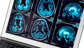 L’Intelligenza Artificiale e i Big Data possono anticipare le mosse della sclerosi multipla