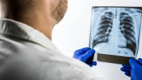 Errore medico, quando spetta il risarcimento? Il caso del tumore scoperto in ritardo
